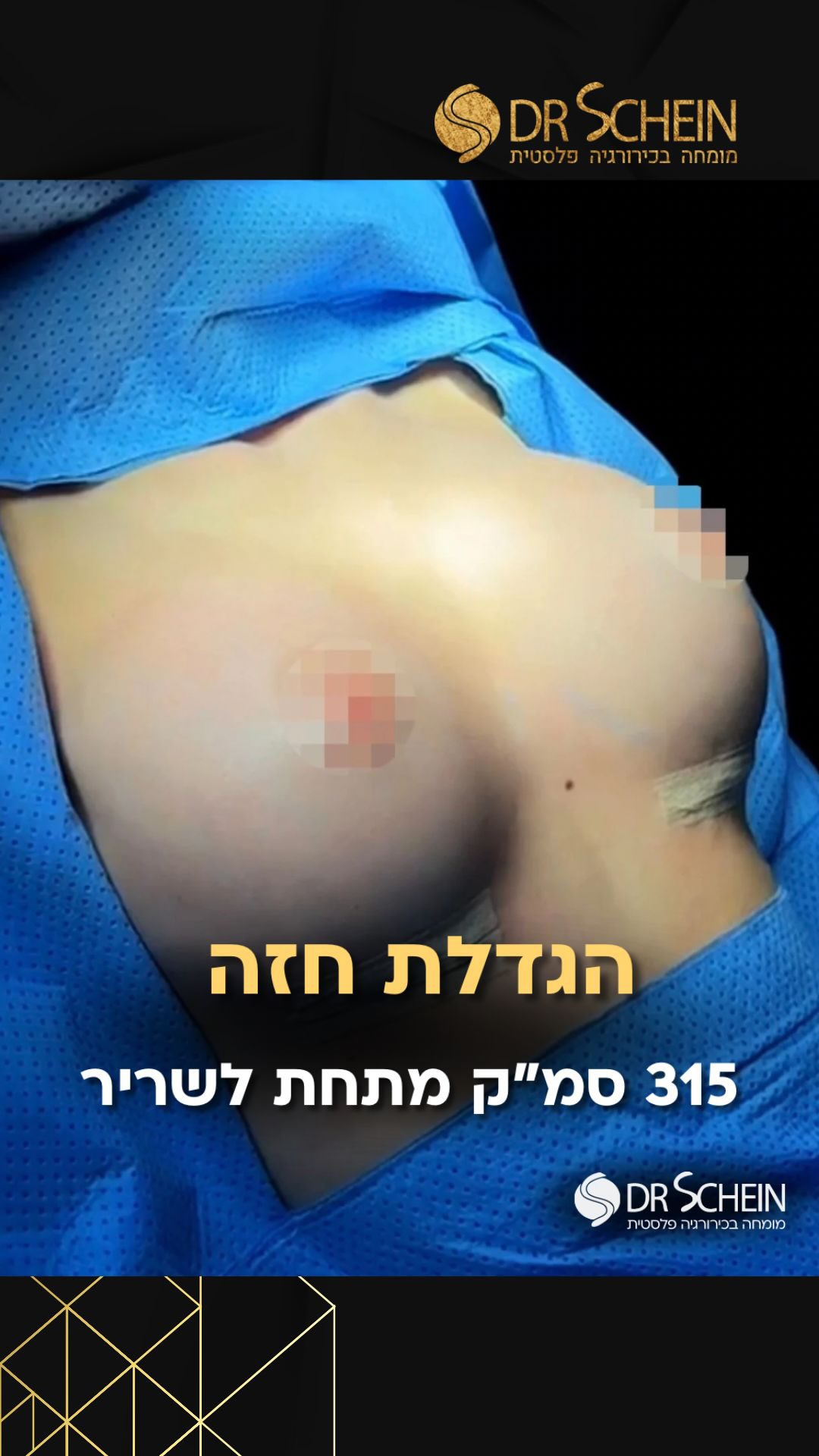הגדלת חזה עם שתלים בנפח 315 סמ״ק מתחת לשריר היא בחירה נפוצה