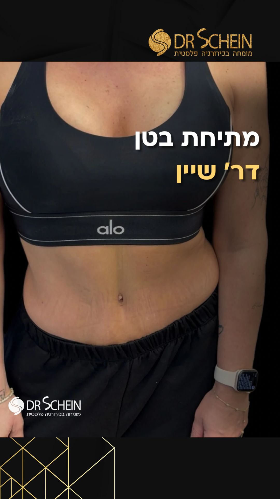 בת 35 מתיחת בטן של דר׳ שיין