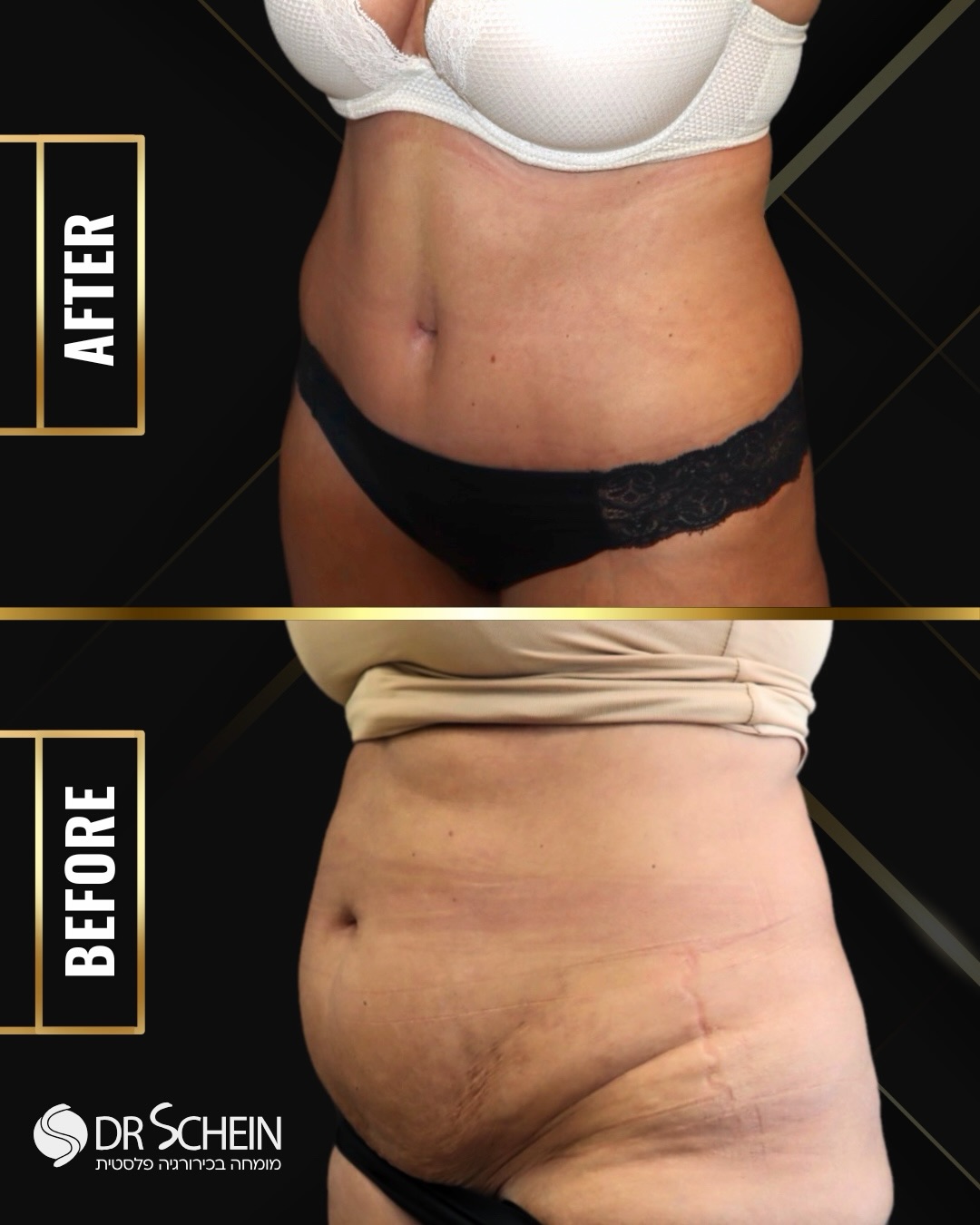 חודש אחרי מתיחת בטן של ד״ר שיין ✨
במהלך הניתוח הוסרו עודפי עור ושומן, בוצע הידוק של שרירי הבטן, והבטן עוצבה מחדש למראה חטוב ומעוצב.
הטבור הותאם למיקום טבעי והחתך הוסתר בקו התחתונים.

כבר בשלב הזה ניתן לראות בטן מהודקת, קונטור מודגש ושיפור משמעותי במבנה הגוף.
📲 למידע נוסף - ניתן גם לפנות למרפאה בוואטספ 03-6424942.
כל המטופלות והמטופלים שלנו מאשרים בכתב את פרסום החומרים ושמחים על כך. לעולם לא נעלה חומרים ללא אישור. כל התוכן המובא הינו למטרות לימוד בלבד.
•
•
•
#מתיחתבטן #מתיחתבטןללאנקזים #מתיחתבטןמלאה