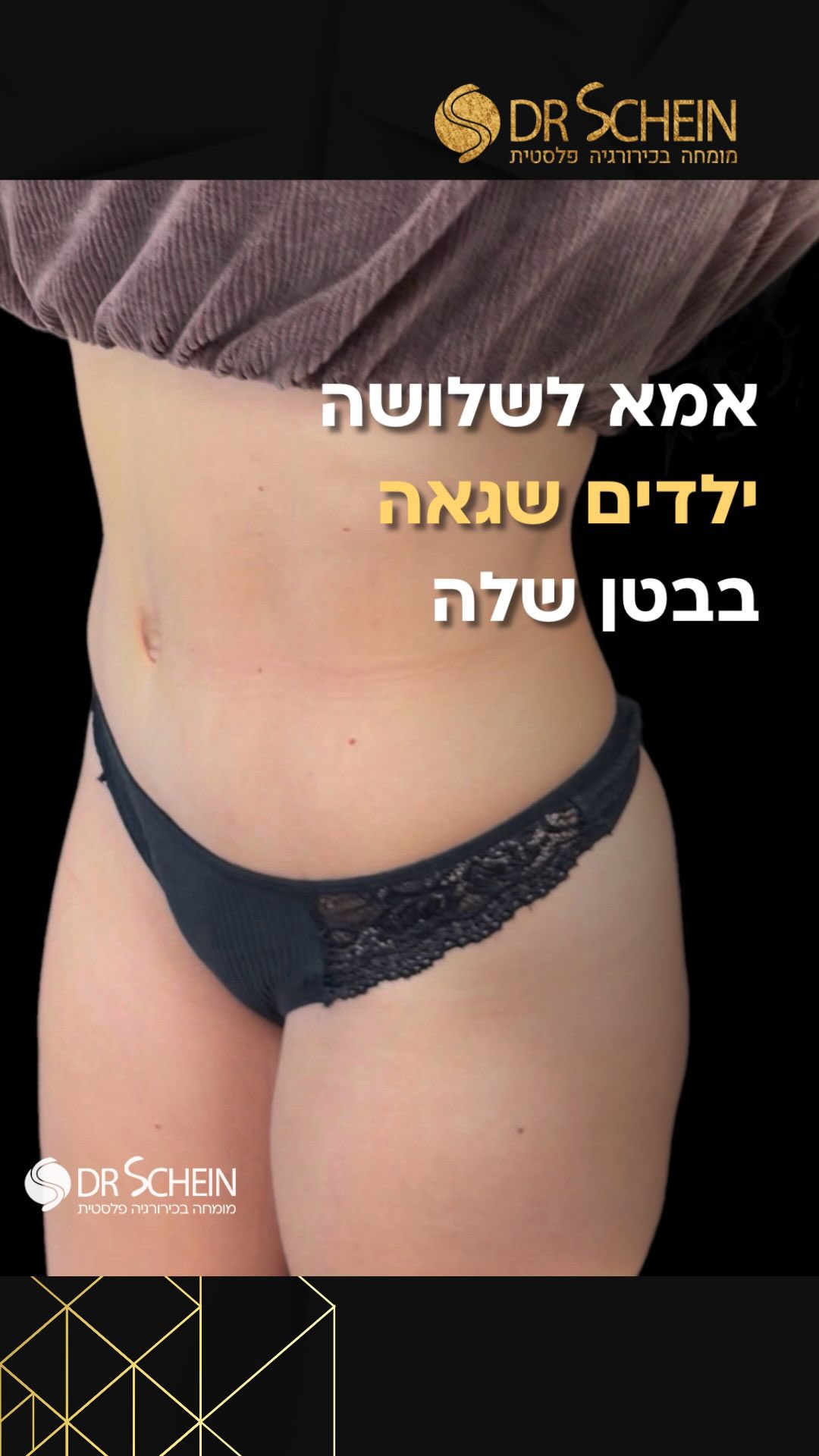 אנסטסיה, אמא לשלושה ילדים, משתפת בתהליך שעברה.
לאחר הריונות ותקופה ארוכה שבה הבטן כבר לא הרגישה “שלה”, אנסטסיה עברה מתיחת בטן שהחזירה לדופן הבטן מראה חטוב מעוצב.
כיום היא מדווחת על שיפור משמעותי בתחושת הגוף, בנוחות היומיומית ובביטחון העצמי - לובשת בגדים צמודים, מרגישה חופשייה ובטוחה גם בביקיני בים.
בעקבות השינוי בבטן והחוויה החיובית מהתהליך, אנסטסיה בחרה להמשיך ולטפל גם באזור החזה, כחלק מגישה הוליסטית שמטרתה התאמה כוללת של הגוף לשלב החיים הנוכחי שלה.
ואנחנו נמשיך לעדכן בהמשך התהליך ובתוצאה הסופית 👌
📲 למידע נוסף - ניתן גם לפנות למרפאה בוואטספ 03-6424942.
*כל המטופלות והמטופלים שלנו מאשרים בכתב את פרסום החומרים ושמחים על כך. לעולם לא נעלה חומרים ללא אישור. כל התוכן המובא הינו למטרות לימוד בלבד.*
•
•
•
#מתיחתבטן #מתיחתבטןללאנקזים #מתיחתבטןאחריהריון