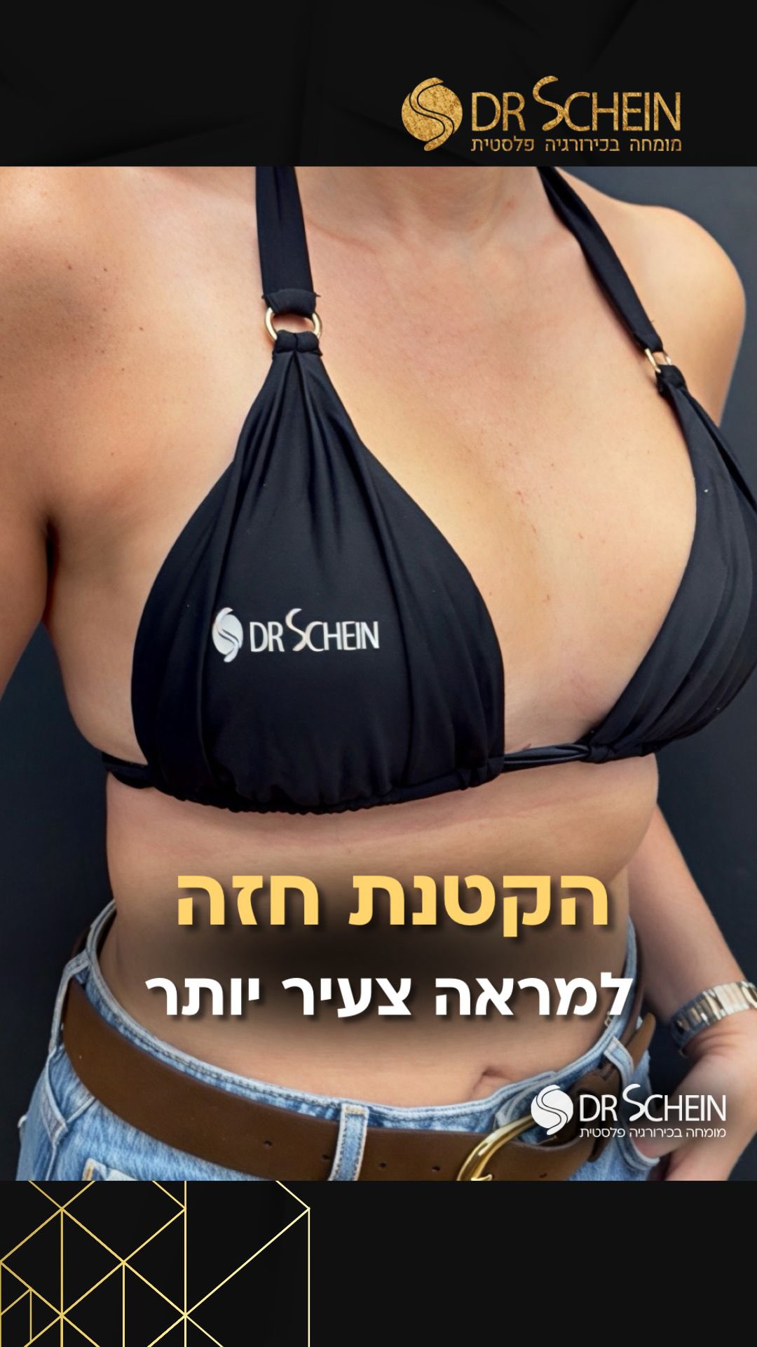 בת 49, חודש לאחר הקטנה והרמת חזה. מטרת הניתוח להפחית גודל ולהחזיר לחזה מנח טבעי ומורם. ההליך תרם לשיפור בפרופורציות הגוף ולמראה צעיר יותר.
📲 למידע נוסף - ניתן גם לפנות למרפאה בוואטספ 03-6424942.
*כל המטופלות והמטופלים שלנו מאשרים בכתב את פרסום החומרים ושמחים על כך. לעולם לא נעלה חומרים ללא אישור. כל התוכן המובא הינו למטרות לימוד בלבד.*
•
•
•
#הקטנתחזה #הקטנתחזהללאנקזים #הרמתחזה