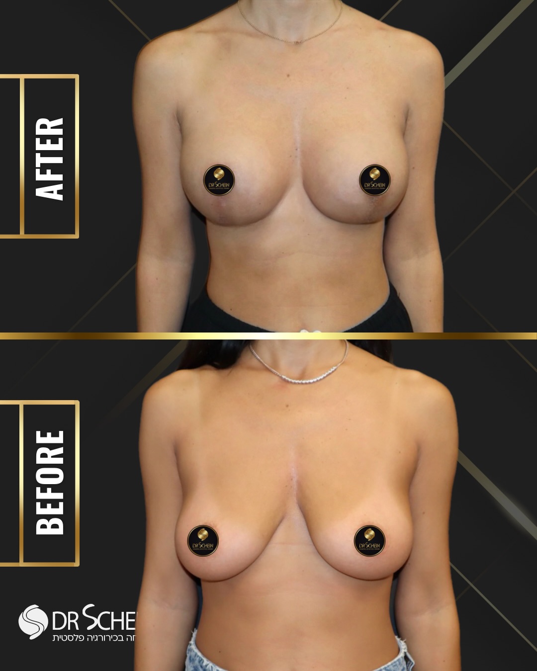 🔹גיל המטופלת: 36
🔹 זמן מהניתוח: חודש
🔹 סוג הניתוח: הרמת חזה עם שתל
🔹 סוג השתלים: שתלי פוליאוריטן עגולים, פרופיל בינוני, נפח 195 סמ״ק
🔹 הרדמה: מקומית
🔹 גישה ניתוחית: תת־שדית
🔹 אשפוז: ללא אשפוז
📲 למידע נוסף - ניתן גם לפנות למרפאה בוואטספ 03-6424942.
כל המטופלות והמטופלים שלנו מאשרים בכתב את פרסום החומרים ושמחים על כך. לעולם לא נעלה חומרים ללא אישור. כל התוכן המובא הינו למטרות לימוד בלבד.
•
•
•
#הרמתחזה #הרמתחזהעםשתלים #הרמתחזהבהרדמהמקומית #schein_cleavage