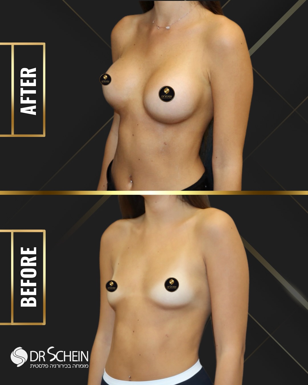 ⁨	⁨	בת 24 חודש לאחר הגדלת חזה של ד״ר שיין בהרדמה מקומית 💎
נפח השתלים 275 סמ״ק שהונחו מתחת לשריר. 
לייק אם אהבת את התוצאה ♥️ 
📲 למידע נוסף - ניתן גם לפנות למרפאה בוואטספ 03-6424942.

כל המטופלות והמטופלים שלנו מאשרים בכתב את פרסום החומרים ושמחים על כך. לעולם לא נעלה חומרים ללא אישור. כל התוכן המובא הינו למטרות לימוד בלבד.*
•
•
•
#הגדלתחזה #הגדלתחזהבישראל #הגדלתחזהבהרדמהמקומית #schein_cleavage⁩⁩