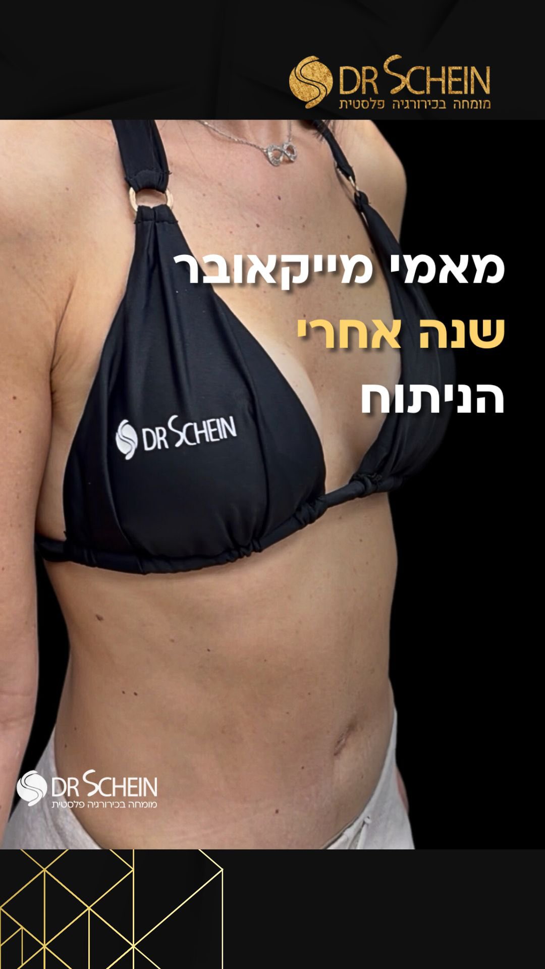 ⁨	שנה עברה מאז שהמטופלת המדהימה הזאת הגשימה חלום.
אחרי הריונות ולידות היא בחרה בעצמה ועברה מאמי עם מייקאובר אצל ד״ר שיין.
ההחלמה הושלמה ולפניה חיים שלמים של אהבה עצמית, ביטחון ושלמות עם הגוף החדש.
💫 מתיחת בטן בשילוב עם הרמת חזה היא לא רק שינוי חיצוני, זו מתנה לעצמך, אחרי שסיימת להביא חיים לעולם.

📲 למידע נוסף - ניתן גם לפנות למרפאה בוואטספ 03-6424942.
*כל המטופלות והמטופלים שלנו מאשרים בכתב את פרסום החומרים ושמחים על כך. לעולם לא נעלה חומרים ללא אישור. כל התוכן המובא הינו למטרות לימוד בלבד.*
•
•
•
#מאמימייקאובר #הרמתיזה #מתיחתבטן #הרמתחזהעםשתלים⁩