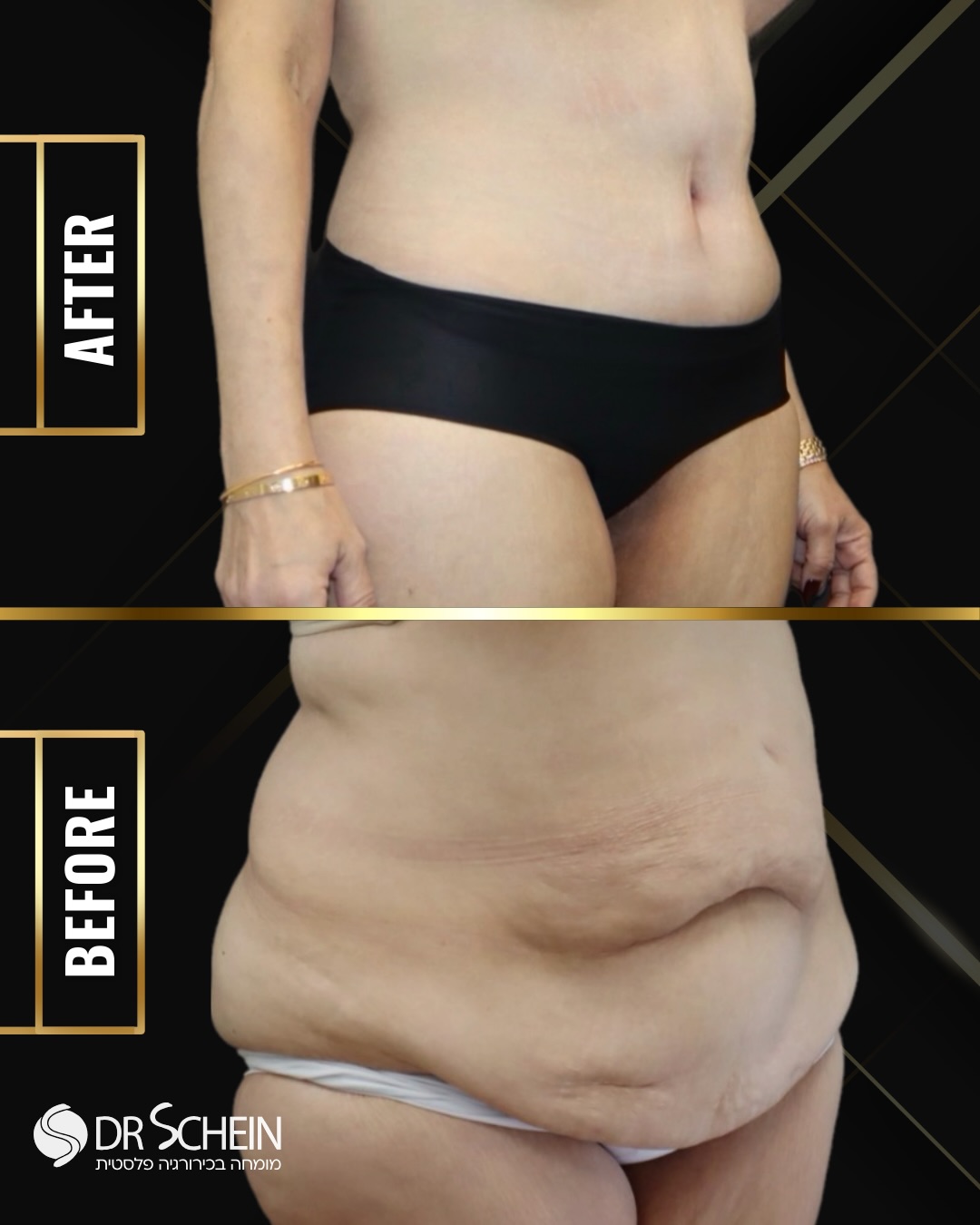 ⁨חודש לאחר מתיחת בטן מוארכת.
מדובר במטופלת לאחר ירידה משמעותית של כ־30 ק״ג במשקל, עם עודפי עור ושומן נרחבים באזור הבטן והמותניים.
במהלך הניתוח הוסרו עודפי עור ושומן, ובוצע עיצוב מחדש של דופן הבטן לקבלת הידוק מיטבי וצרה בהיקף.
כבר בשלב זה של ההחלמה ניתן לראות שיפור משמעותי בפרופורציות הגוף, הפחתה דרמטית בעודף ובצניחת הרקמות.
✨ ברגע שמסירים את מה שכבר לא שייך לגוף - מתגלה מה שהיה שם כל הזמן! 
📲 למידע נוסף - ניתן גם לפנות למרפאה בוואטספ 03-6424942.
*כל המטופלות והמטופלים שלנו מאשרים בכתב את פרסום החומרים ושמחים על כך. לעולם לא נעלה חומרים ללא אישור. כל התוכן המובא הינו למטרות לימוד בלבד.*
•
•
•
#מתיחתבטם #מתיחתבטןמוארכת #מתיחתבטןללאנקזים #מתיחתבטןהיקפית⁩
